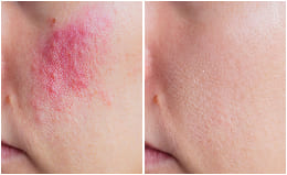 Before and after — blotchy tone