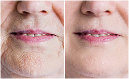 Before and after — crepey skin