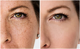 Before and after — dark spots