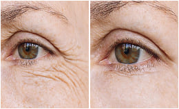 Before and after — fine lines