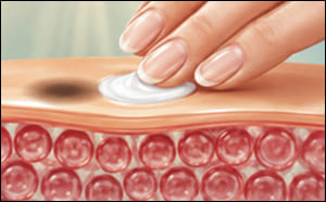 Fading a dark spot on skin