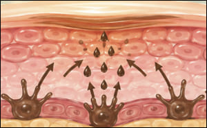 Pigment cells continue overproducing