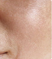 After — dark spots