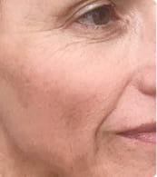 After — crepey skin