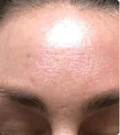 After — uneven tone