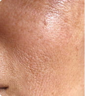 Before — dark spots
