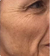 Before — crepey skin