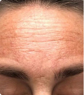 Before — uneven tone