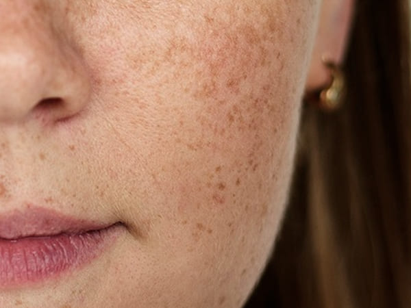 Dark spots on facial skin